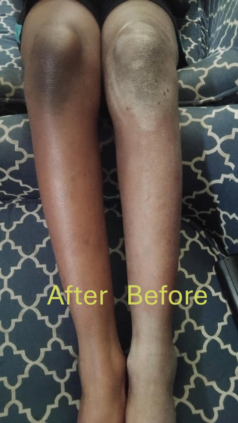 Two legs rest side by side on a patterned surface. The right “Before” leg looks dry and ashy, while the left “After” leg appears moisturized and healthier—highlighting Forev'Herbs Eczema Cream's effect on sensitive skin.